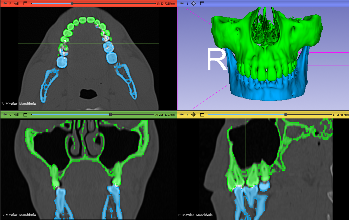 Archivo STL — Mandíbula y maxilar en 3D Slicer